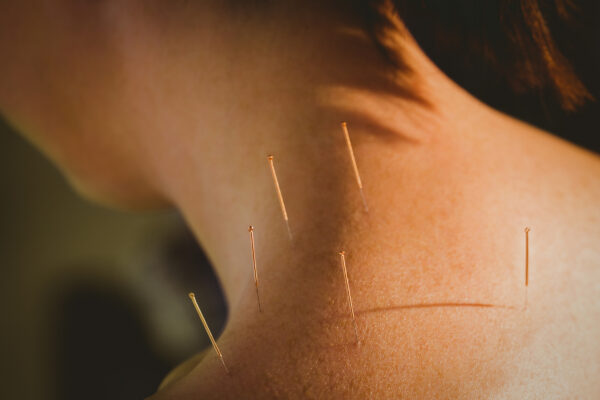 akupunktur-3